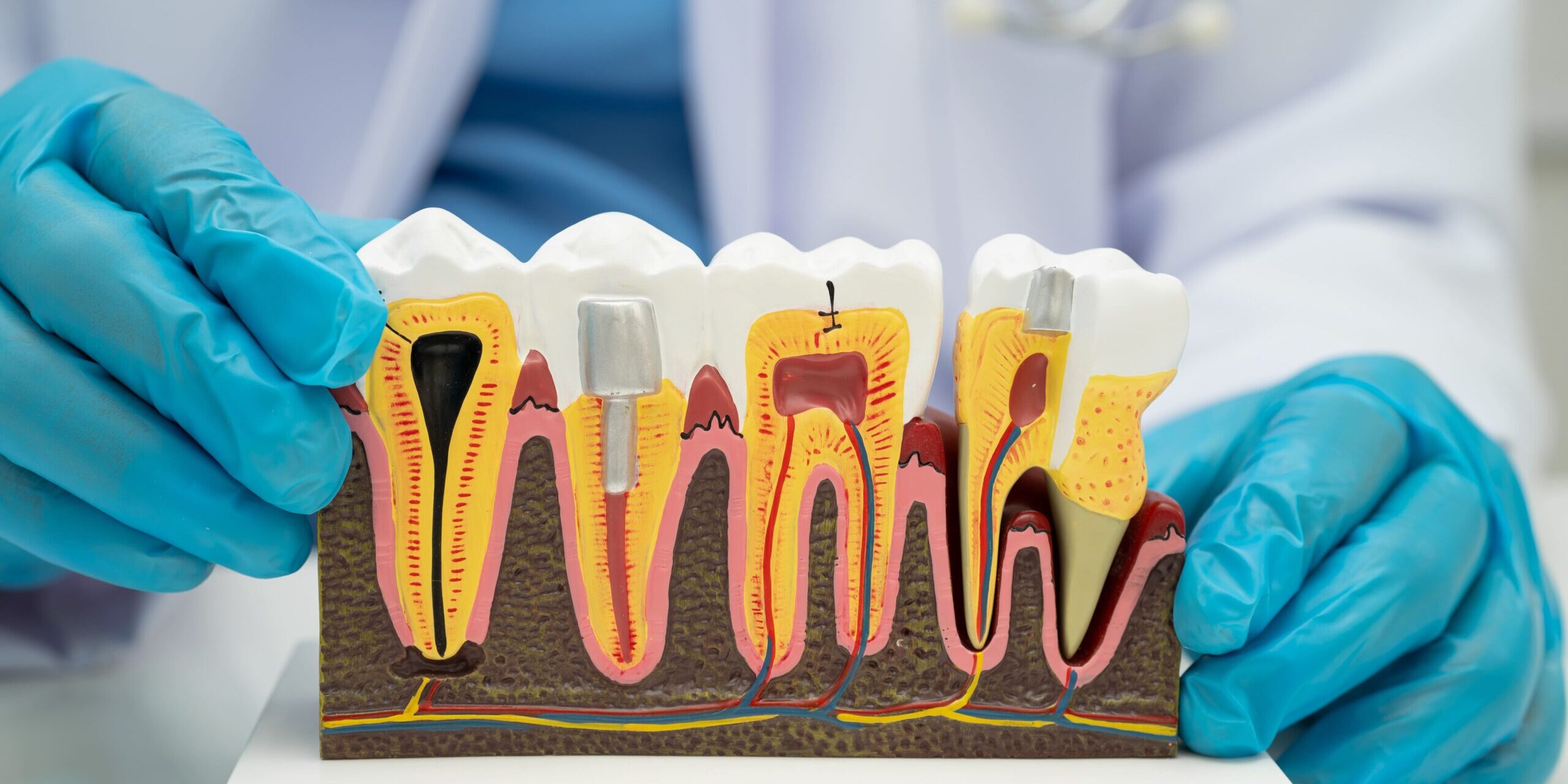 Root canal vs Dental Implant – Ashgrove Root canal vs dental implants