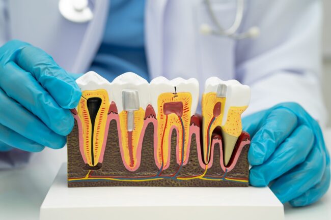 Root canal vs Dental Implant – Ashgrove Root canal vs dental implants