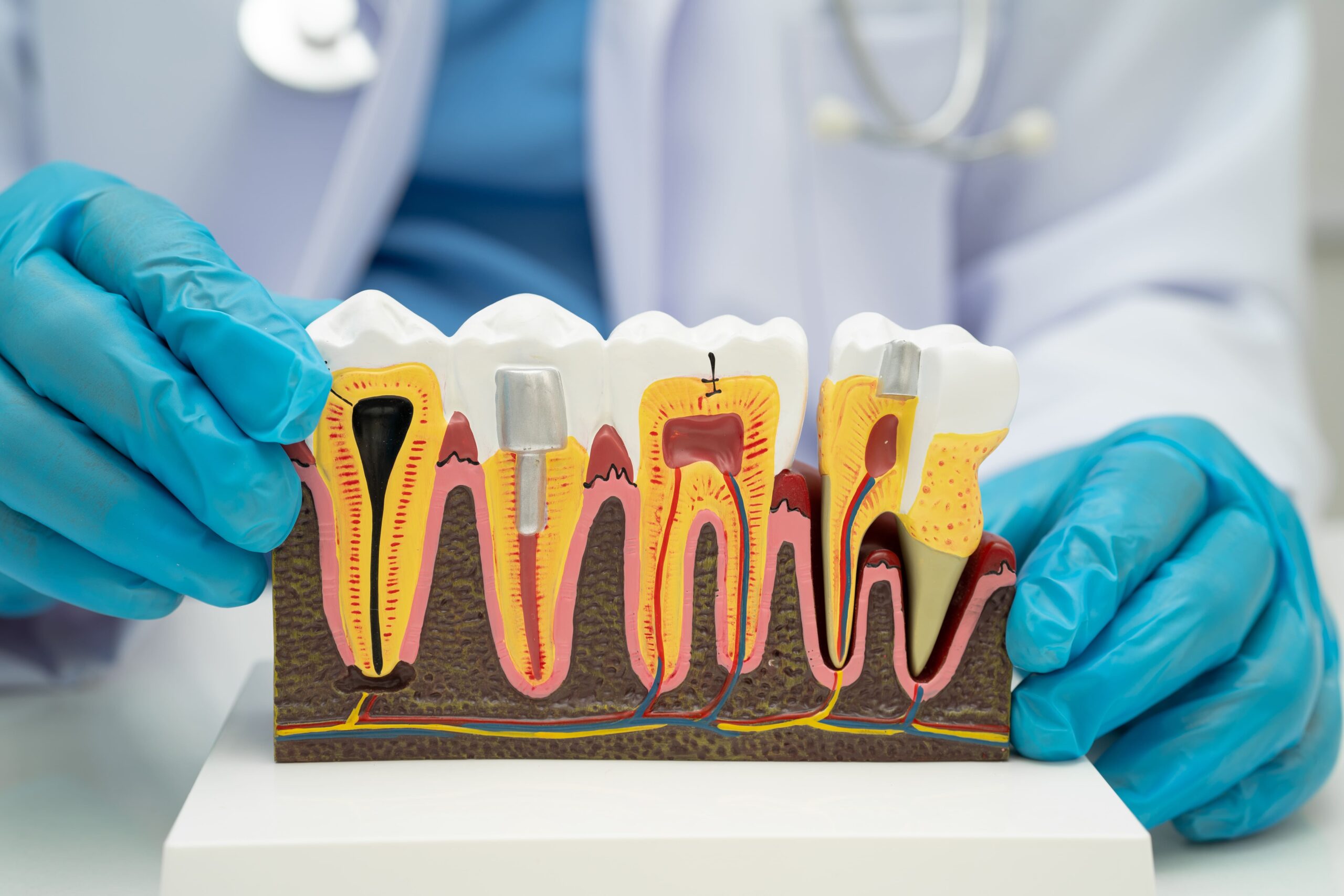 Root canal vs Dental Implant – Ashgrove Root canal vs dental implants